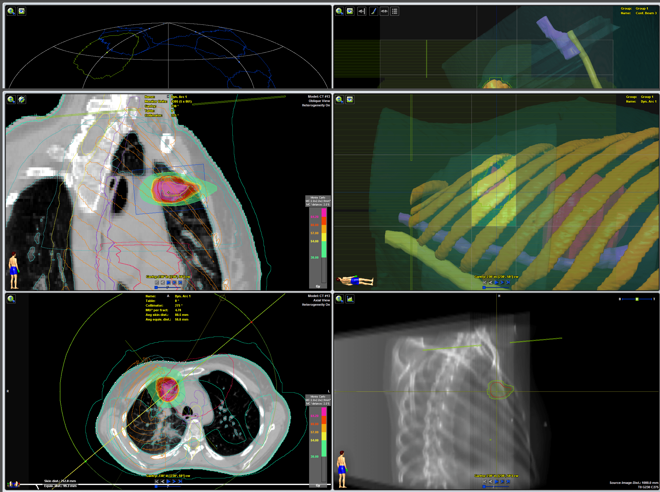 Planeación virtual de tumor en pulmón