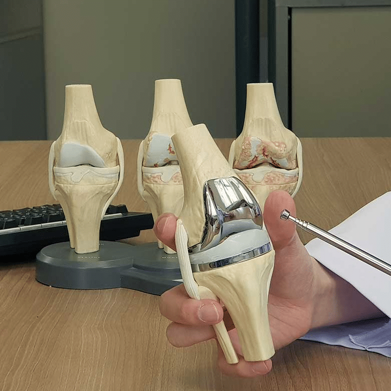 Prótesis de rodilla | Reemplazo de rodilla