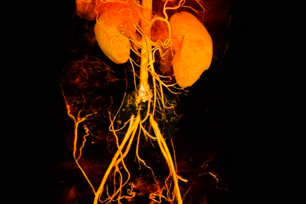 Arterial Obstructiva Aortoiliaca