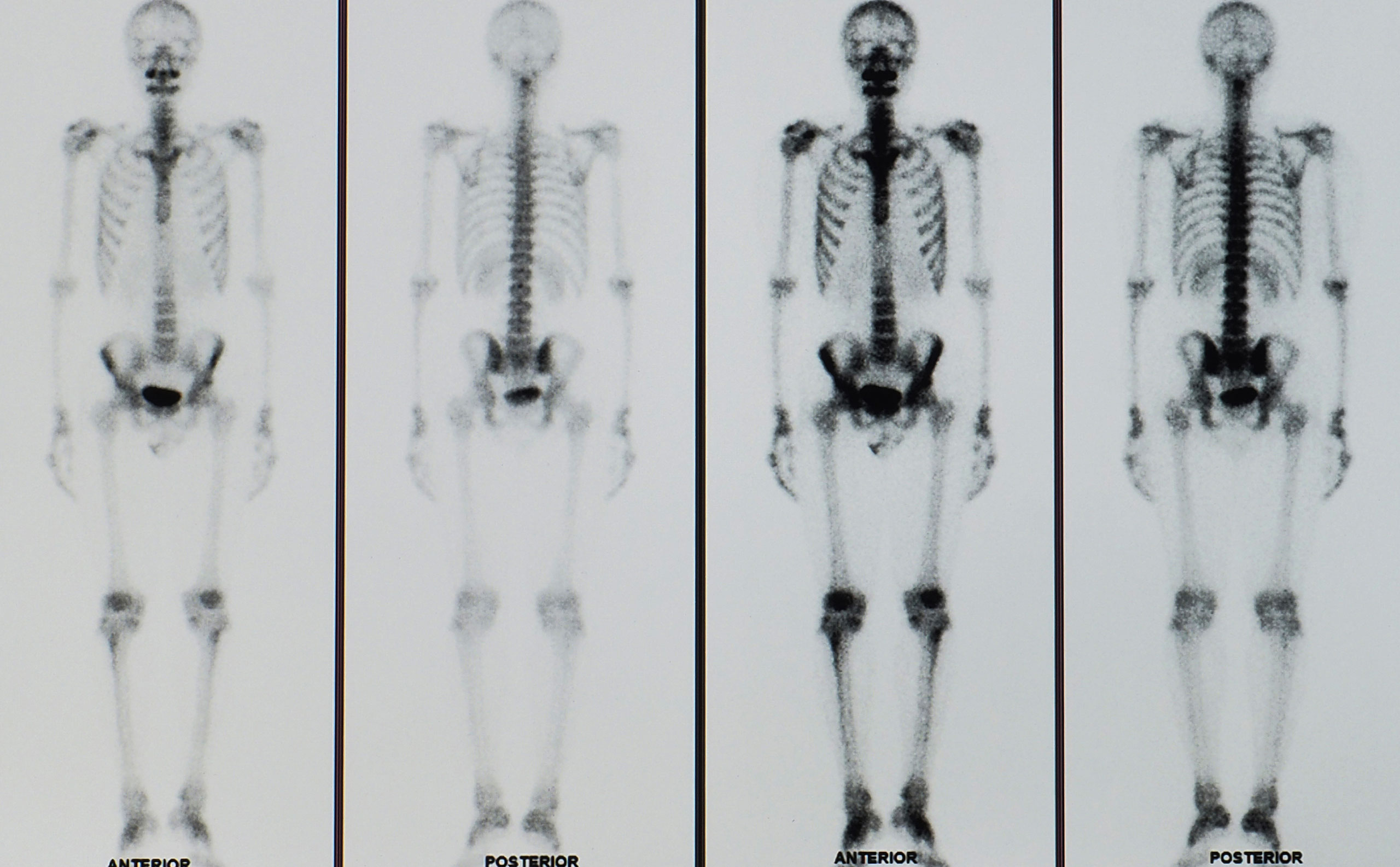 Placas para detectar gammagrafía ósea