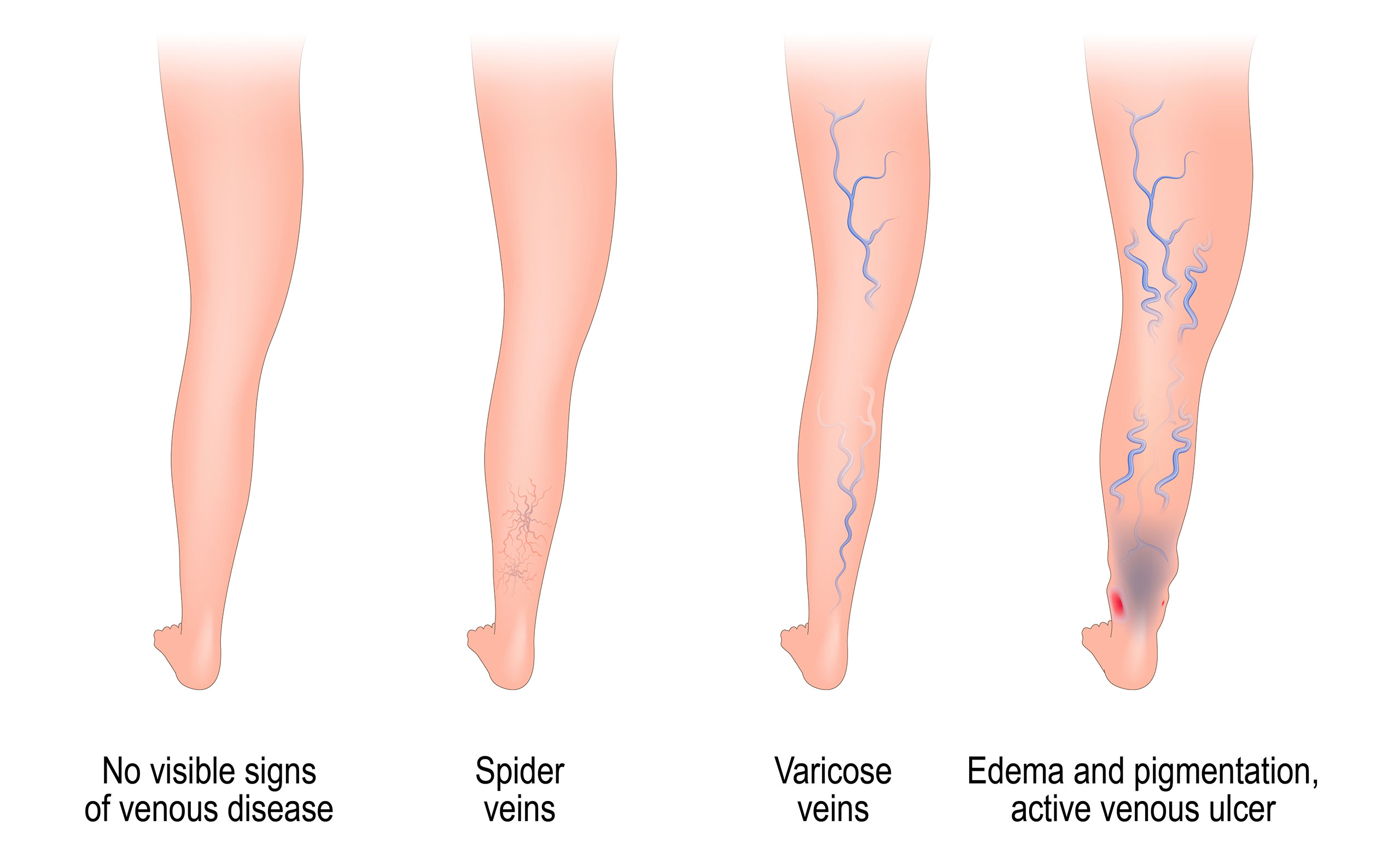 Venous stasis ulcers