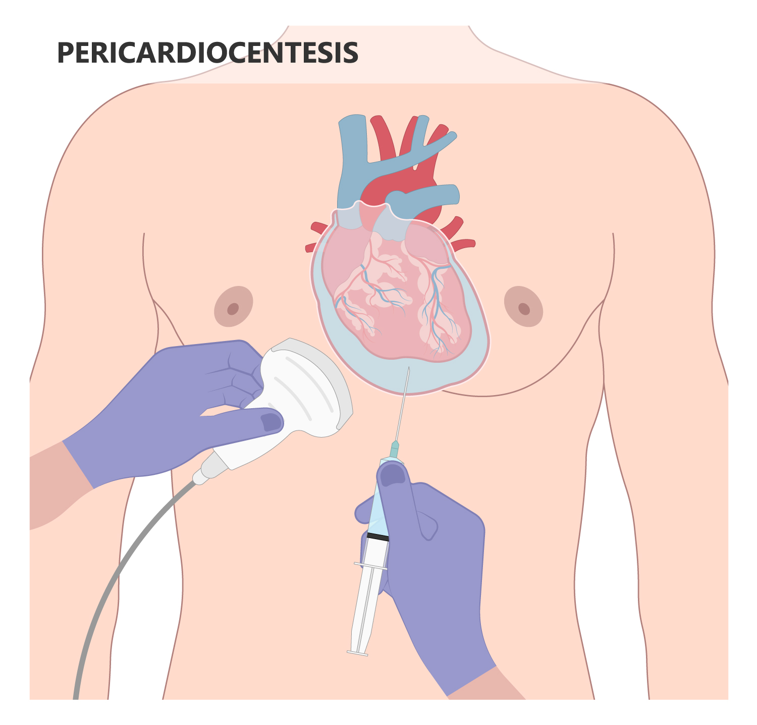 Diagrama pericardiocentesis