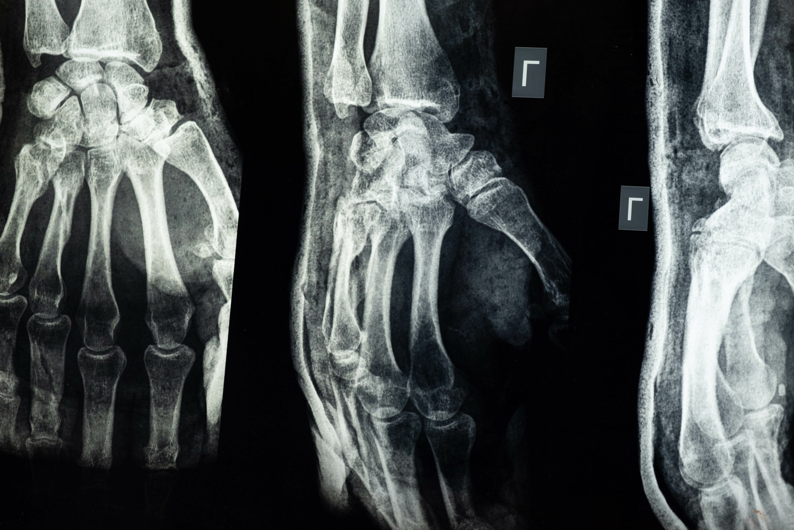 La osteoporosis y las fracturas por fragilidad