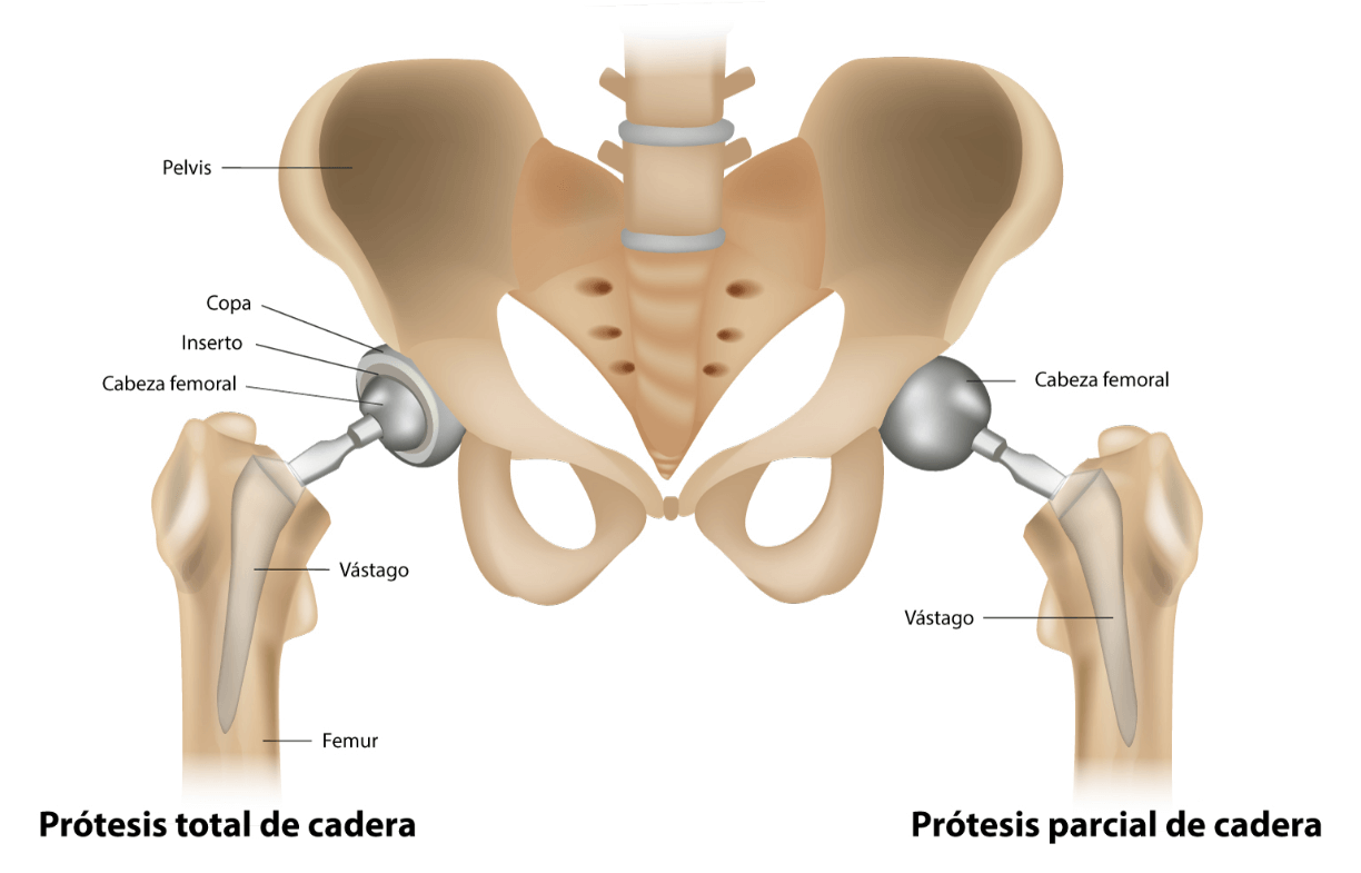 Tipos de protesis cadera