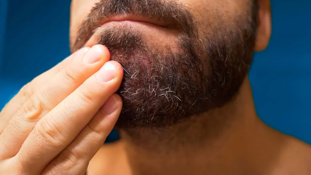 Hombre que se aplica para la foliculitis tratamiento en la barba.