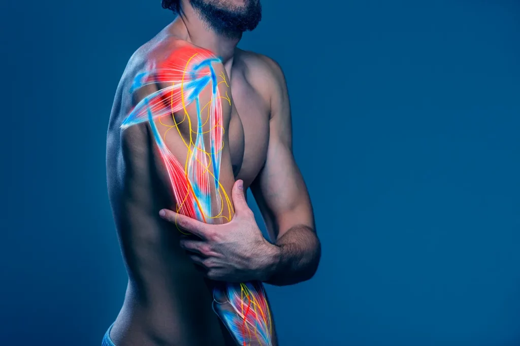 Imagen de un hombre donde se visualizan los nervios del plexo braquial y la musculatura del brazo