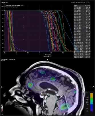 Pathologies can be treated with intracranial radiosurgery (SRS)