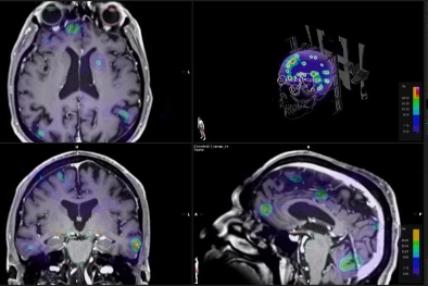 Stereotactic Radiosurgery (SRS)