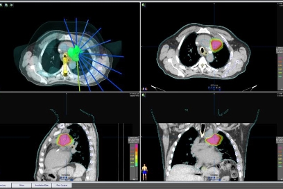 Stereotactic Body Radiation Therapy (SBRT)