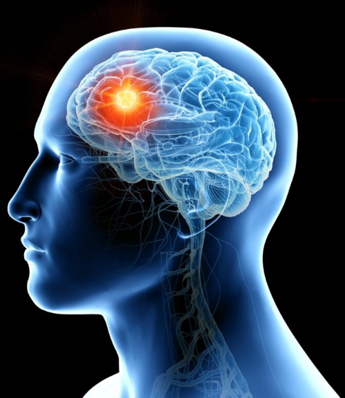 Proyección 3d del cerebro de una persona indicando la ubicación de un turmor cerebral