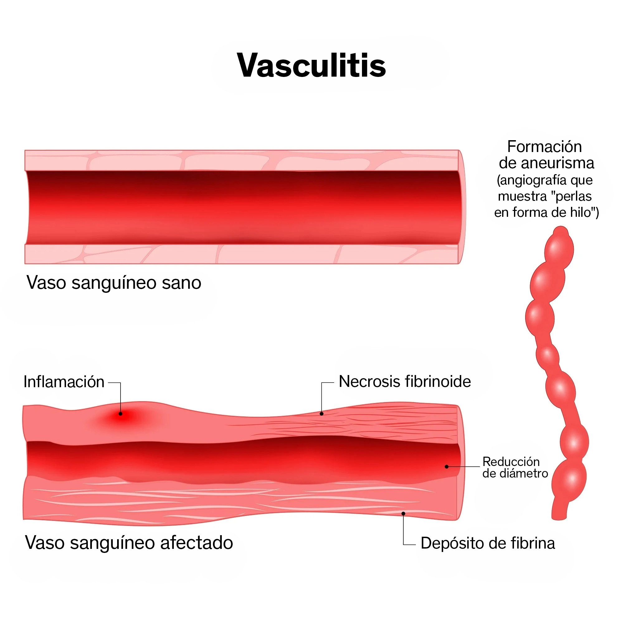 Ilustración donde se muestra cómo se presenta la vasculitis, donde el vaso sanguíneo se daña por la inflamación.