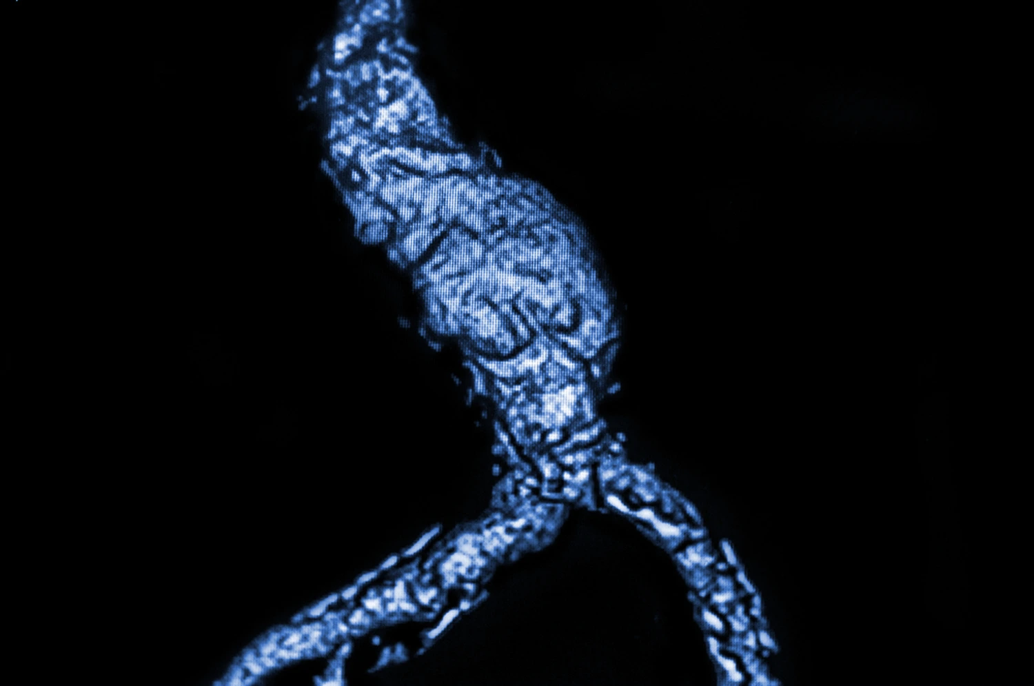 Angiotomografía para el diagnóstico de aneurisma de aorta en un paciente.