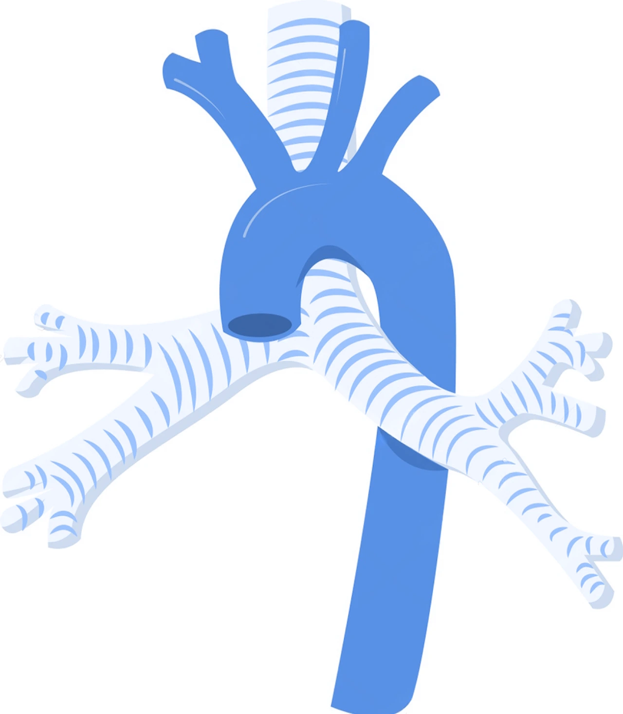 Ilustración de la aorta y la tráquea para ejemplificar lo que es el anillo vascular y el área que puede llegar a afectar.