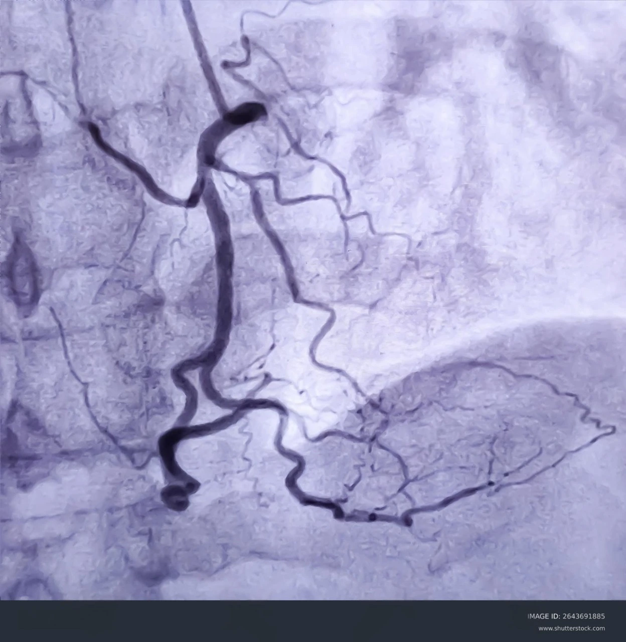 Imagen de una angiografía coronaria, durante un ataque cardíaco, en donde se muestra la arteria coronaria derecha durante el cateterismo cardíaco.