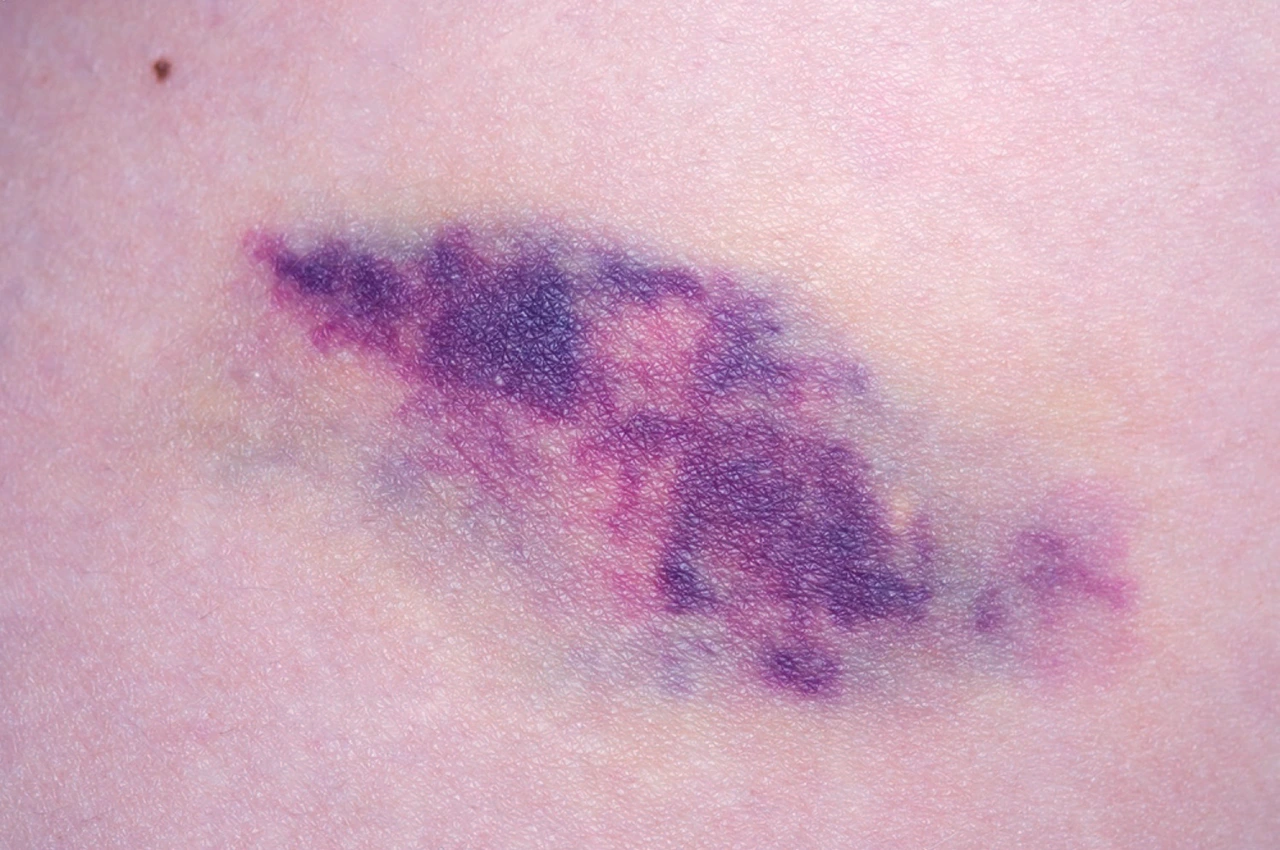 Mancha púrpura en la piel, uno de los signos de la calcifilaxis.