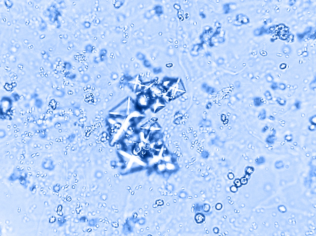 Análisis de orina microscópico como prueba para el diagnóstico de preeclampsia después del parto, para identificar daño renal.