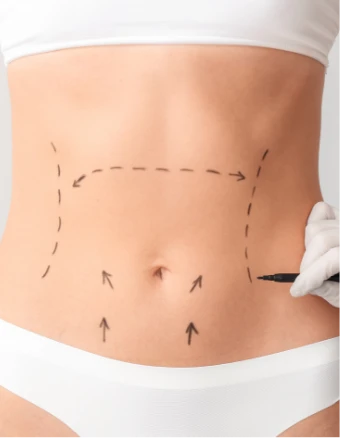 que-es-abdominoplastia Imagen ilustrativa de una mujer que se realizará una abdominoplastia
