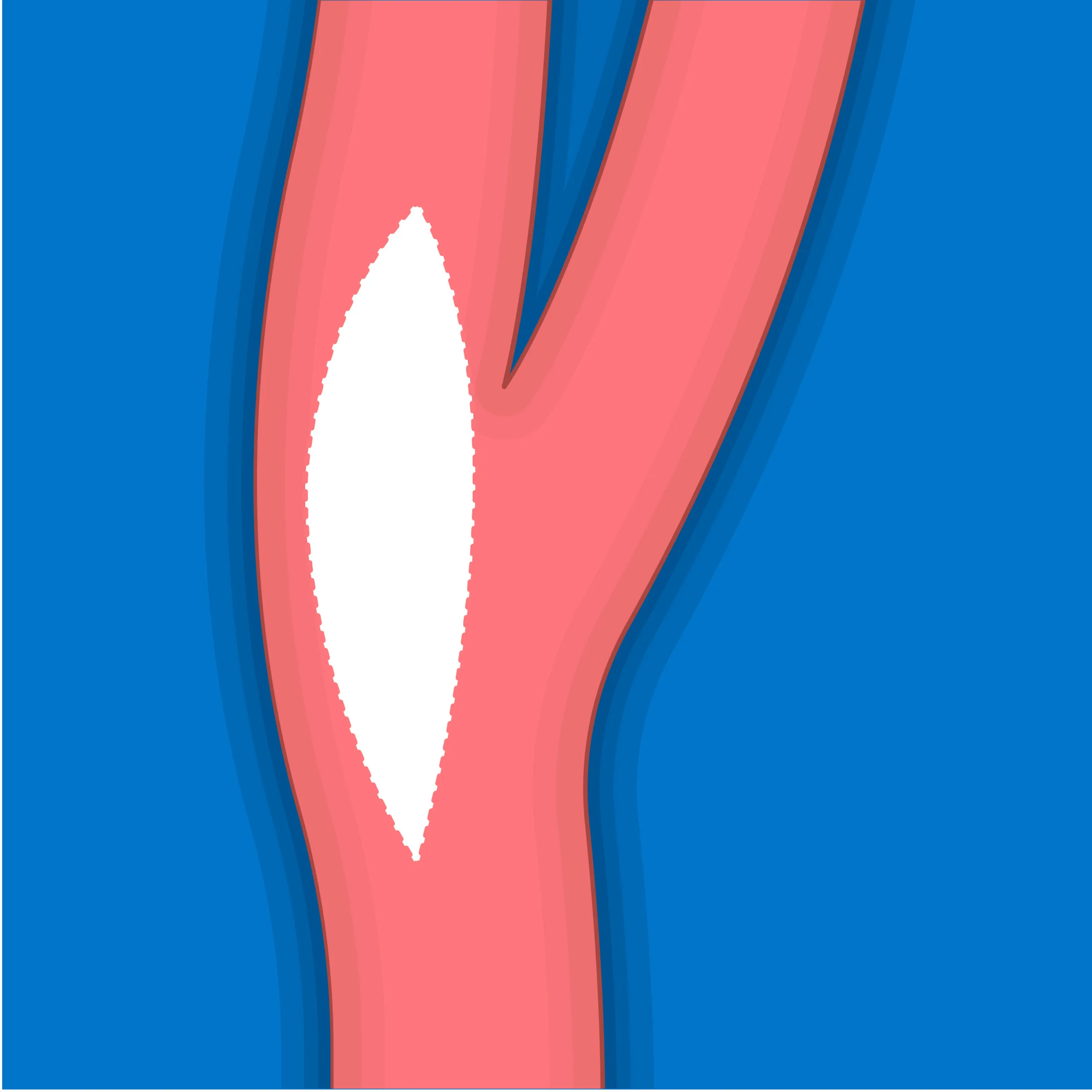 Tratamiento de la enfermedad carotídea