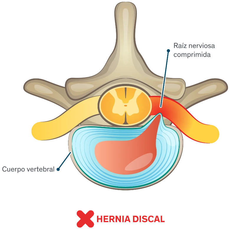 Hernias de disco: síntomas y causas Infografía ilustrada de una hernia de disco en la medula espinal