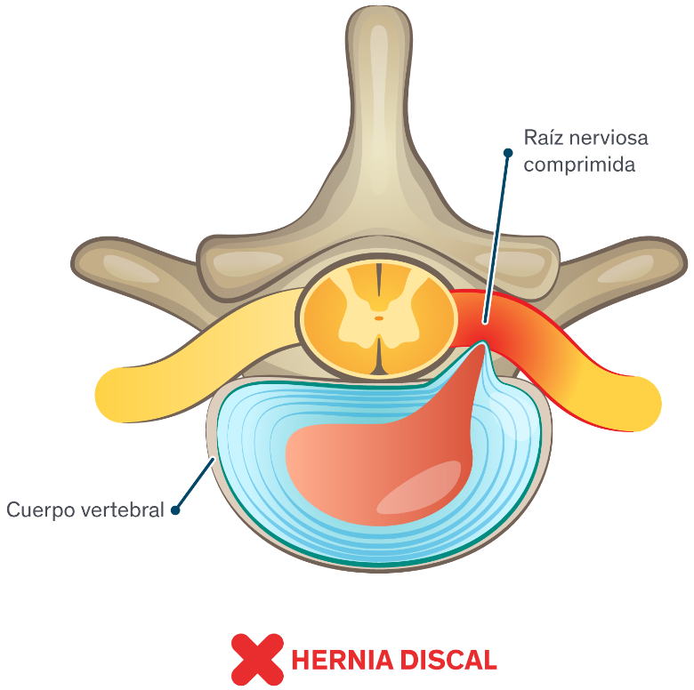 Hernias de disco: síntomas y causas