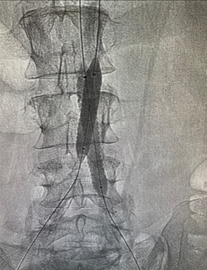 Aortografia con colocacion de stents