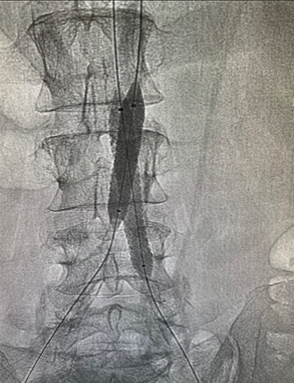 Radiografía donde se visualiza un stent que se ha colocado por la enfermedad arterial obstructiva aortoilíaca. Radiografía donde se visualiza un stent que se ha colocado por la enfermedad arterial obstructiva aortoilíaca.