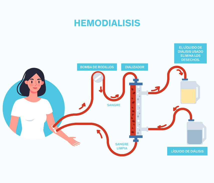 Hemodialysis Diagram