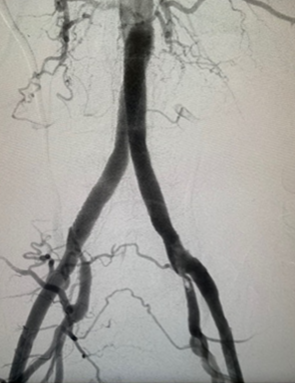 Tomografía de la zona de arterias iliacas ya sin la presencia de enfermedad arterial obstructiva aortoilíaca. Tomografía de la zona de arterias iliacas ya sin la presencia de enfermedad arterial obstructiva aortoilíaca.