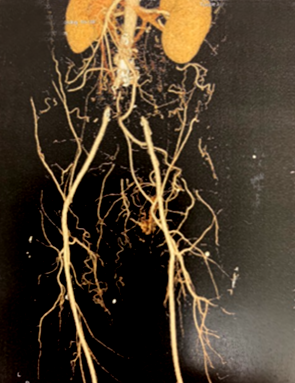 Tomografía de la zona de arterias iliacas donde se ha desarrollado la enfermedad arterial obstructiva aortoilíaca. Tomografía de la zona de arterias iliacas donde se ha desarrollado la enfermedad arterial obstructiva aortoilíaca.
