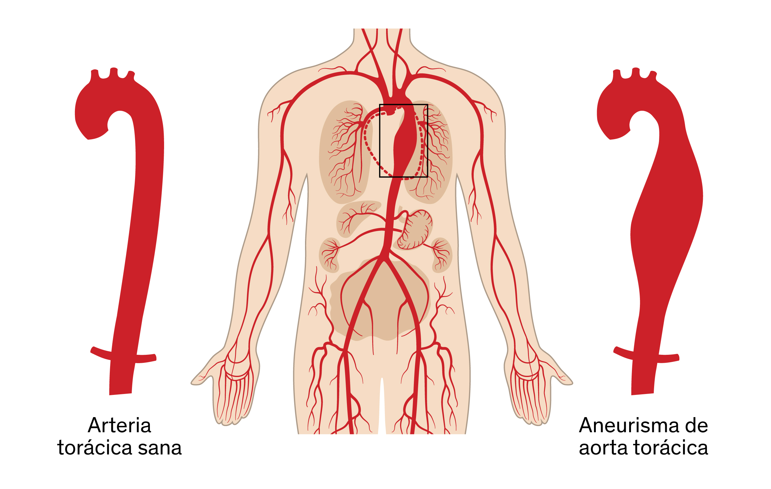 aorta toracica 1