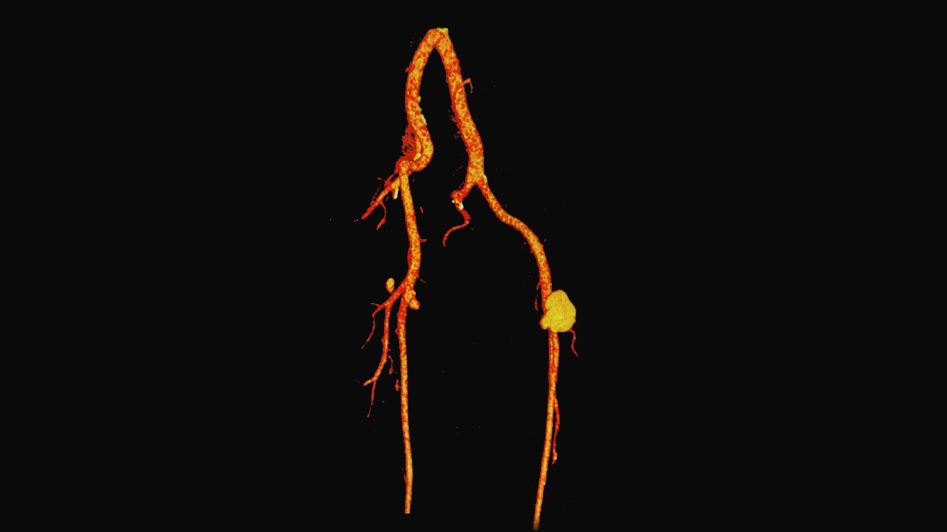 Peripheral artery aneurysms