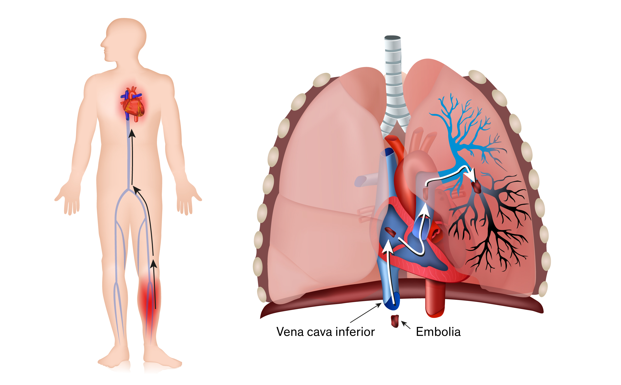 ﻿﻿Tromboembolia pulmonar﻿