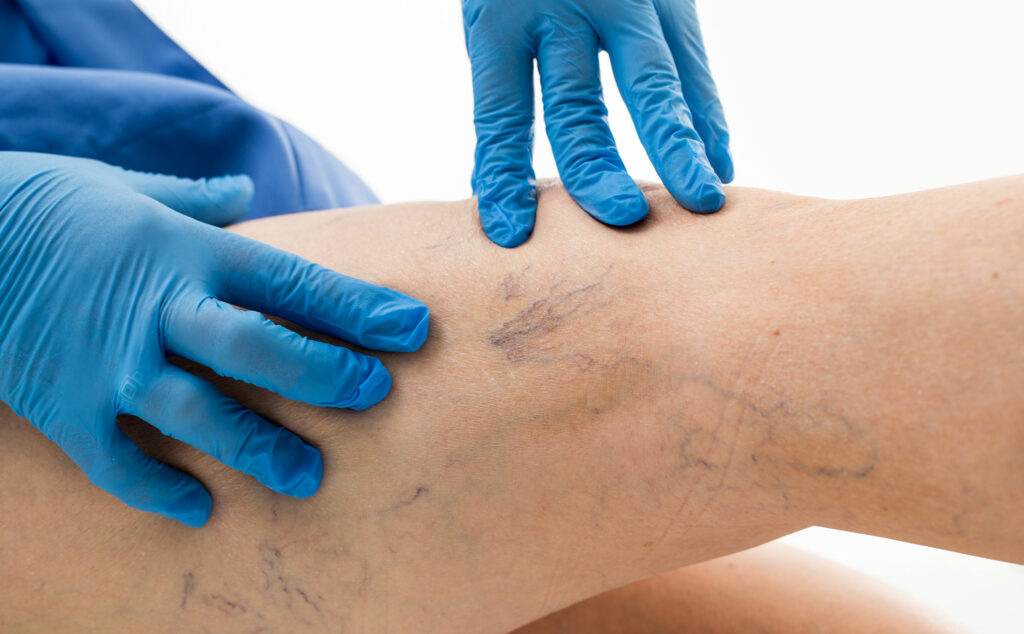 Un médico examina las piernas de un paciente, para identificar las posibles enfermedades de las venas que está presentando.