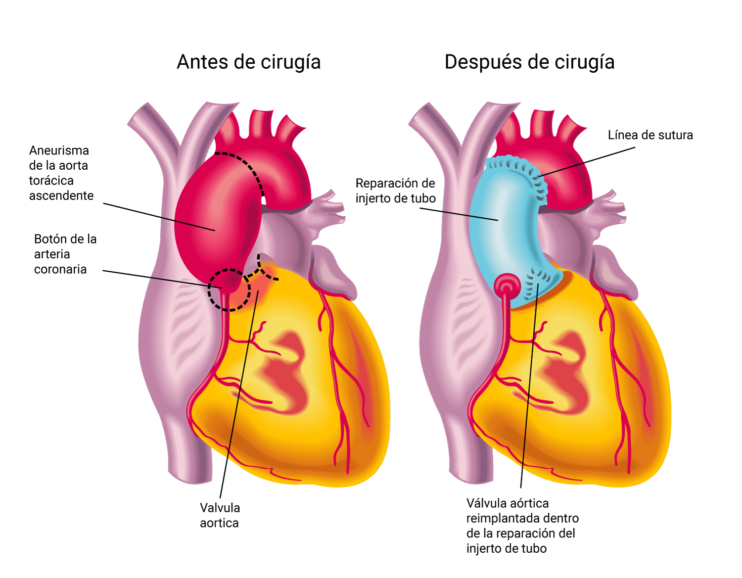 Diagrama antes y después de la cirugía