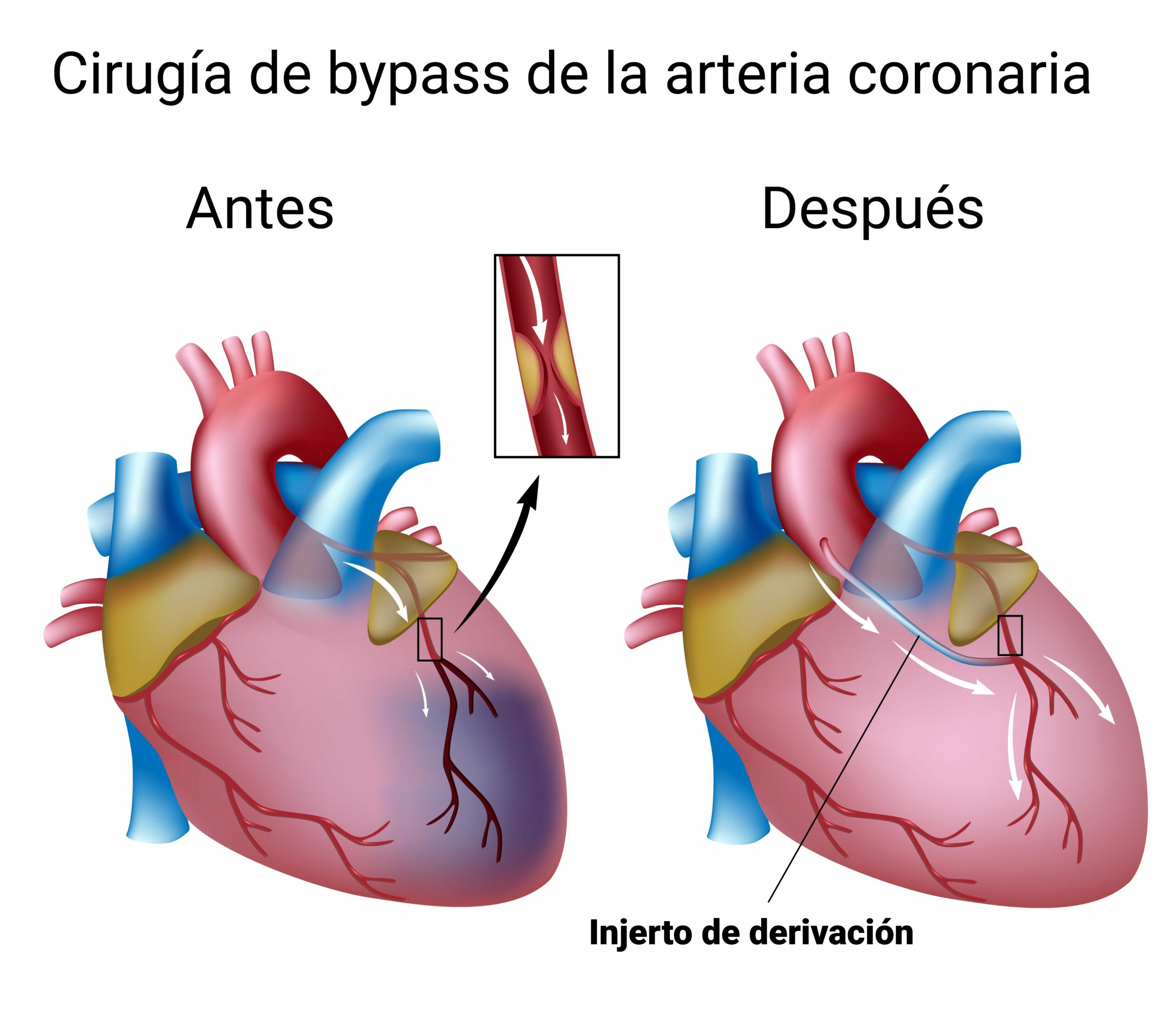 Bypass coronario