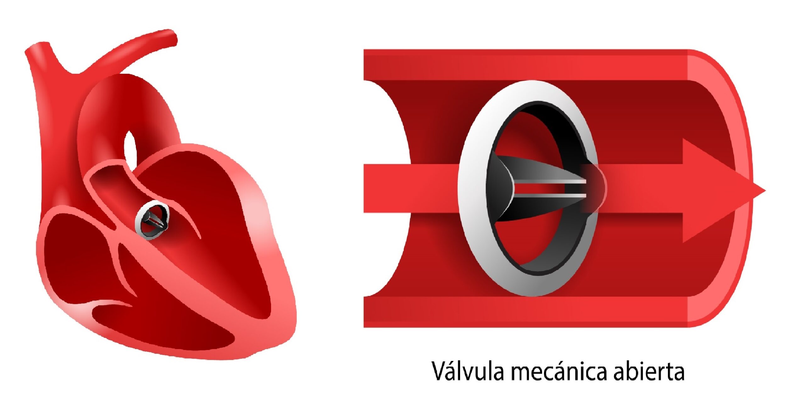 Cirugía de reparación y reemplazo valvular