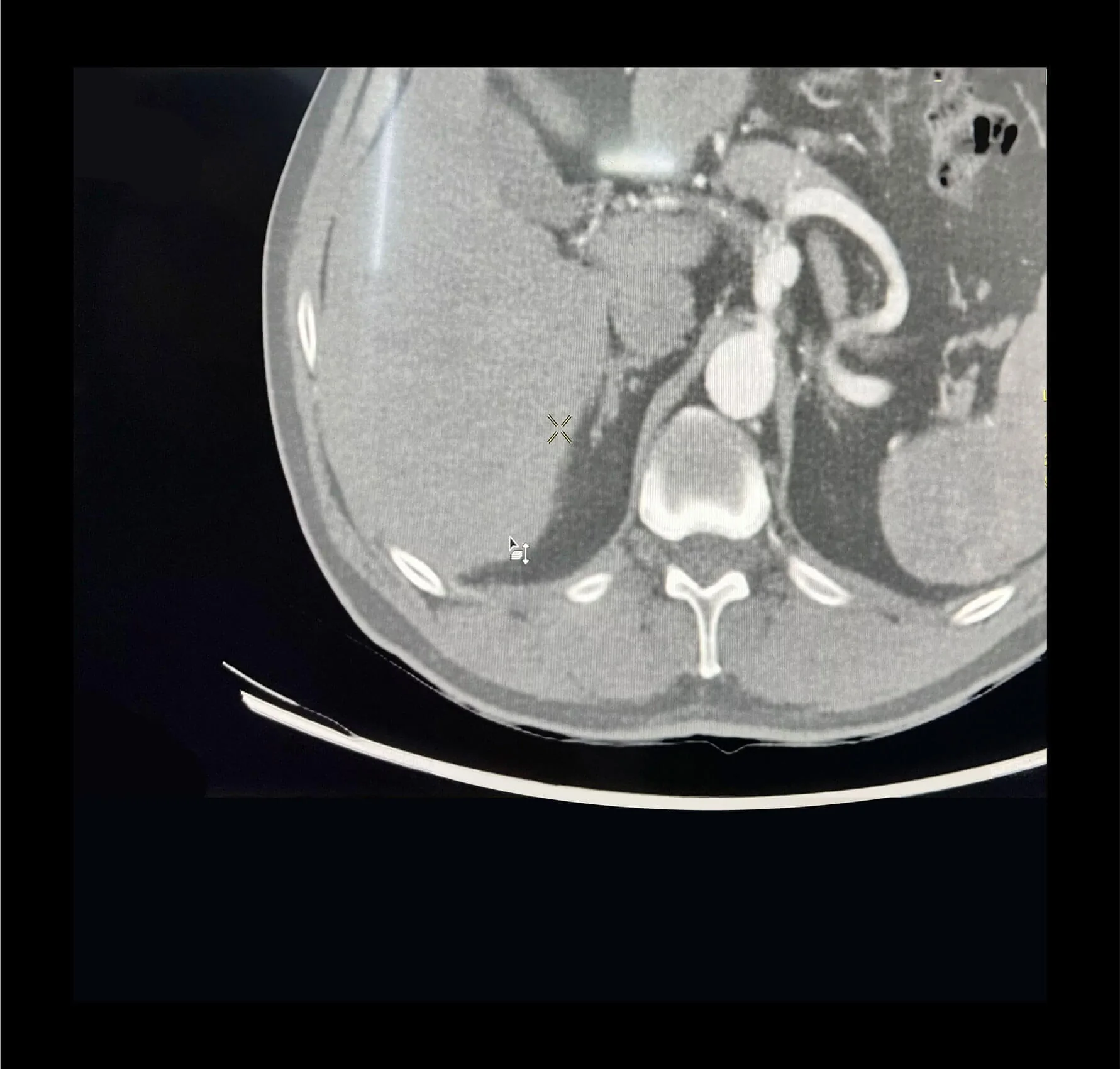 Aneurismas de arterias periféricas