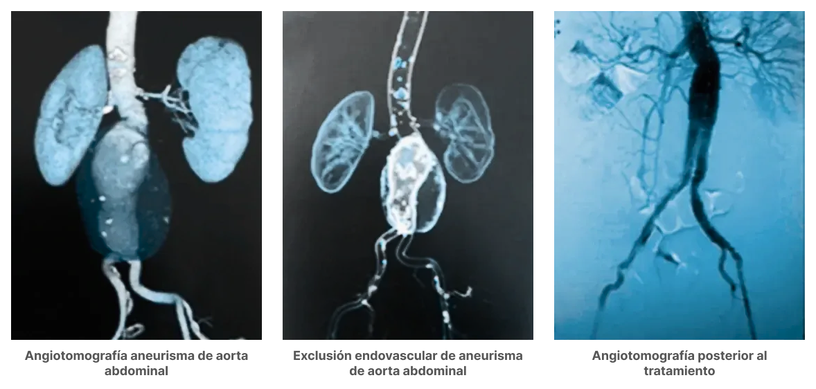 Tres imágenes que permiten conocer cómo es una aneurisma de aorta abdominal para su estudio y diagnóstico. Tres imágenes que permiten conocer cómo es una aneurisma de aorta abdominal para su estudio y diagnóstico.