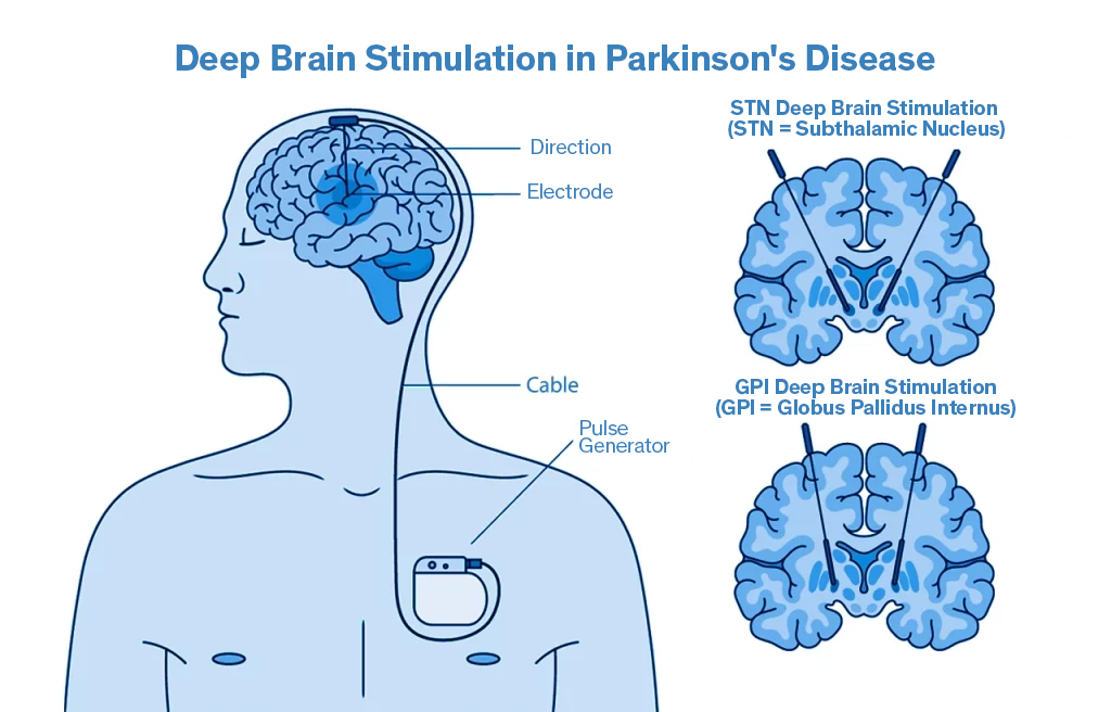 Illustration representing deep brain stimulation in Parkinson’s disease, including its STN and GPi variants
