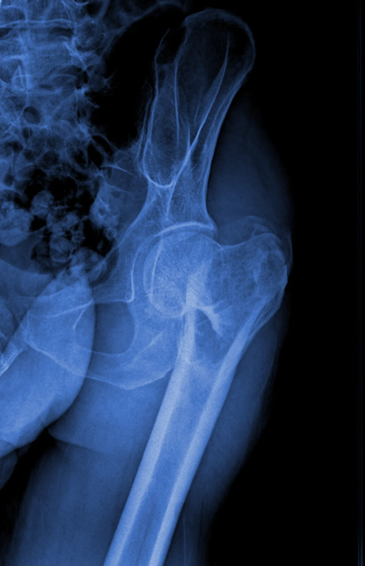 Radiografía de cadera para revisar si hay desgarro en el labrum de la cadera u otra condición que lo esté afectando.