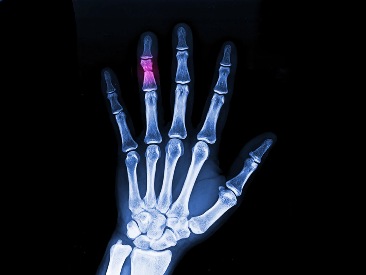 Radiografía de una fractura de dedo donde se muestra el daño en la falange media del dedo anular de una mano.
