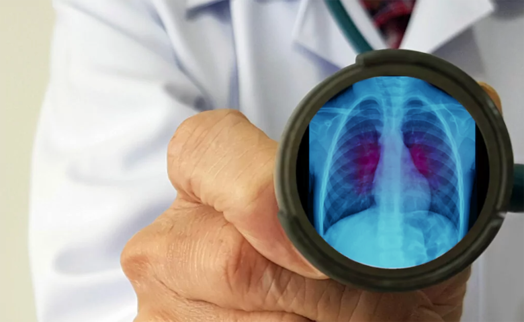 Médico sostiene un estetoscopio, en su interior hay el dibujo de una radiografía de tórax para ejemplificar el daño por virus sincitial respiratorio.