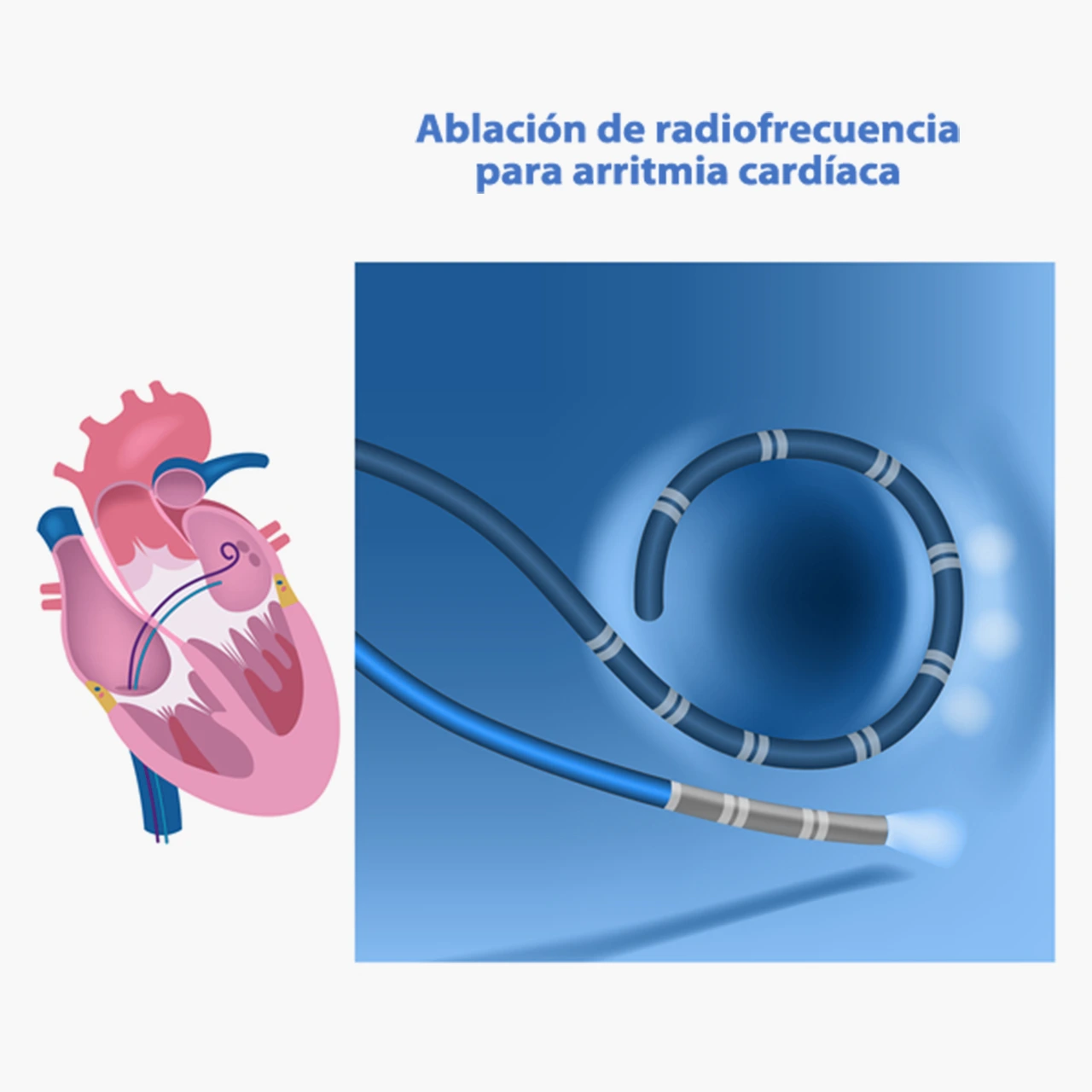 Dibujo que representa una ablación cardíaca mediante la técnica de radiofrecuencia.