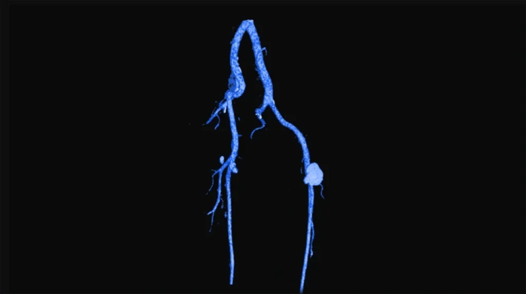 Dibujo que representa un aneurisma periférico en una de las arterias que están en las extremidades de una persona. 