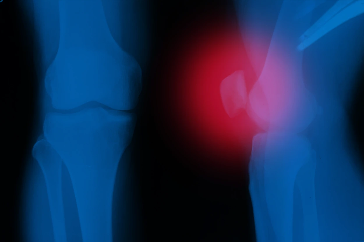 Radiografía de paciente que presenta artritis séptica en la rodilla.