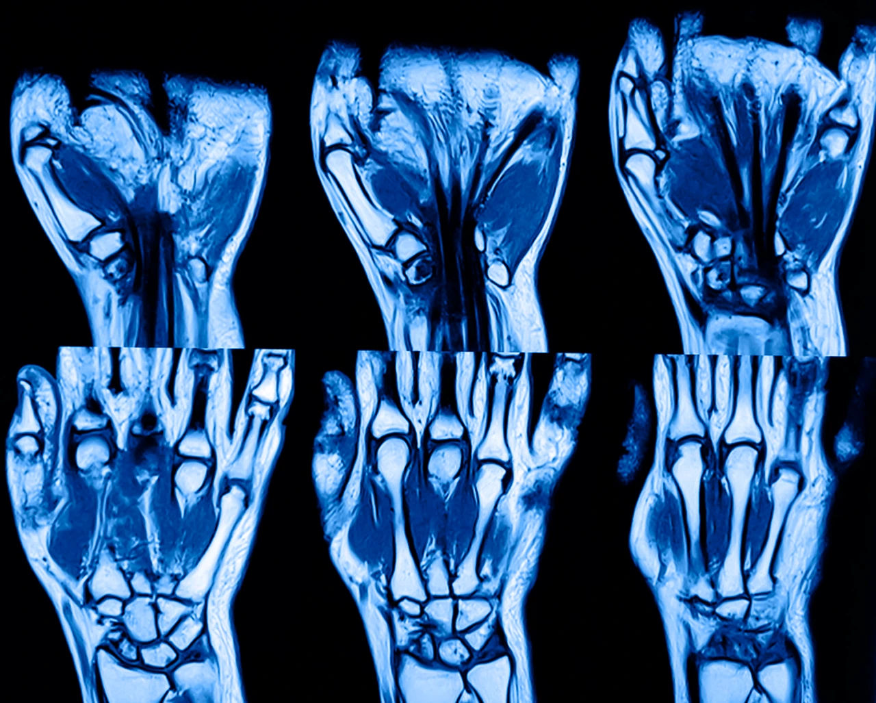 Resonancia magnética para identificar si hay dolor cubital en muñeca u otra condición médica que afecte esta zona del cuerpo.