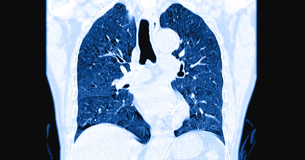 TAC de un paciente, como procedimiento diagnóstico para identificar si ha desarrollado una embolia pulmonar.