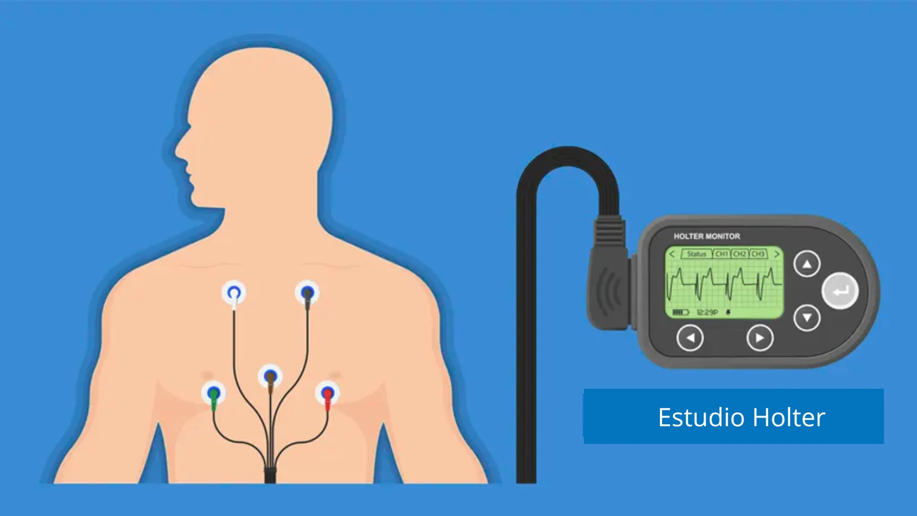 Dibujo que representa a una persona realizándose el estudio Holter 24 horas, con electrodos en el área del pecho.