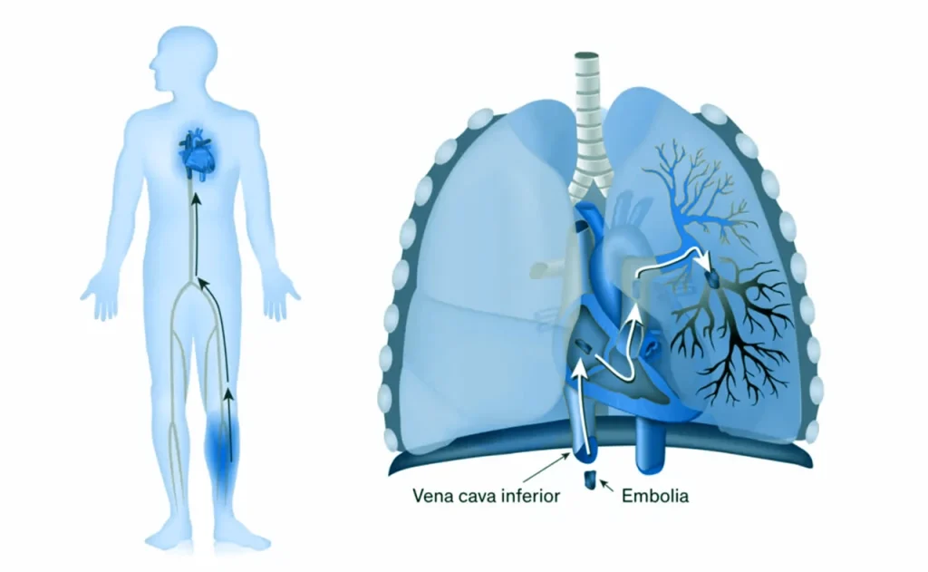 Dibujo a la izquierda de un cuerpo humano y arterias en la pierna, a la derecha el dibujo de unos pulmones y corazón para representar el tromboembolismo pulmonar.

