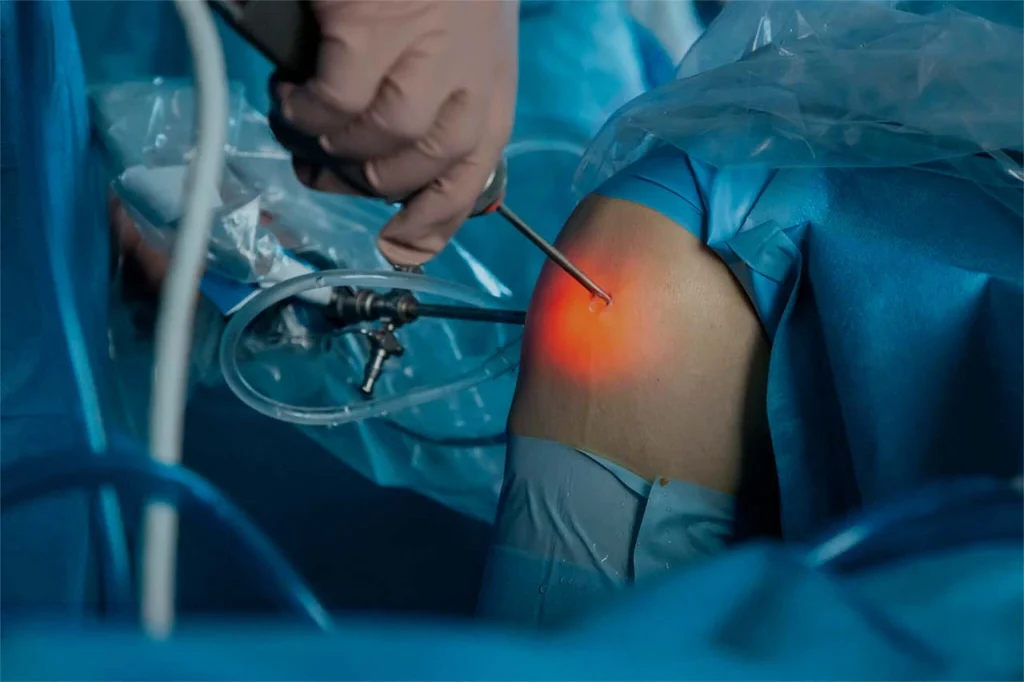 Procedimiento de artroscopia realizada en la rodilla de un paciente, un cirujano sostiene el artroscopio en una mano. Procedimiento de artroscopia realizada en la rodilla de un paciente, un cirujano sostiene el artroscopio en una mano.